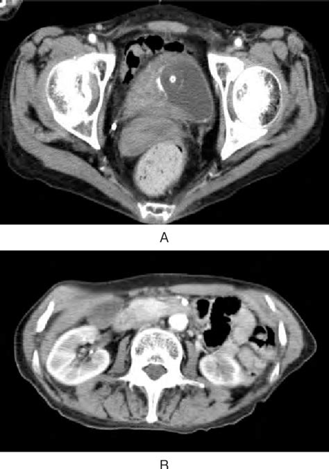 Pdf A Case Of Eosinophilic Cystitis Mimicking An Invasive Bladder