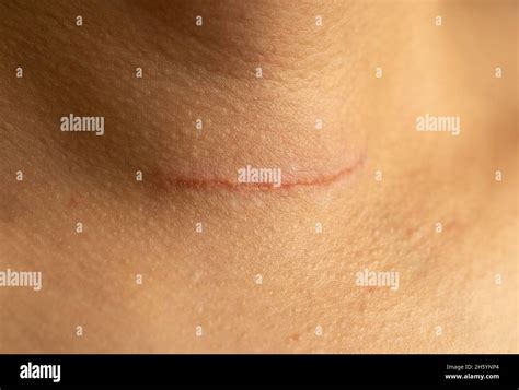 Close Up Photo Of A Woman With Surgical Wound Accured Due To Goiter