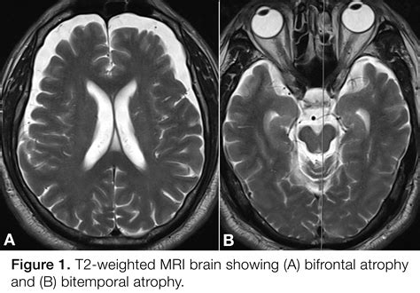 Pet Mri Imaging In Parkinson Dementia Complex Of Guam A