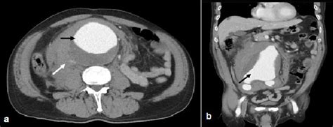 A Contrast Enhanced Computed Tomography Cect Scan Of Abdomen In