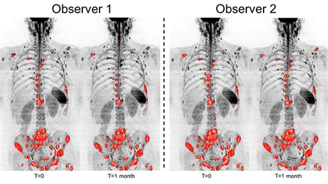 Whole Body Scans Could Track Cancer In Patients Skeletons