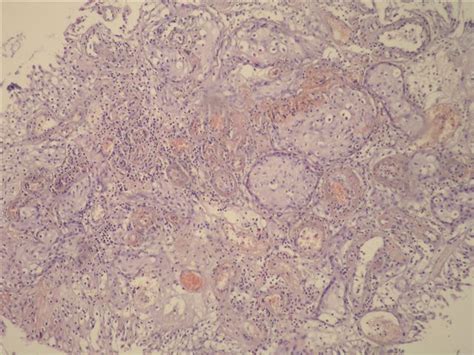 Pathology Outlines Pseudocarcinomatous Epithelial Hyperplasia