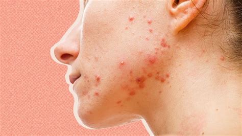 Acne Symptoms Causes And Treatment Question My Health