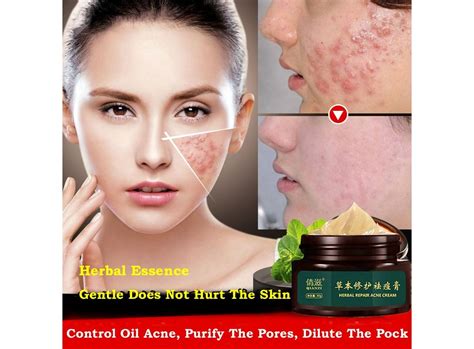 Herbal Acne Cream Anti Pimple Spot Acne Scars Blackhead Removal Cream