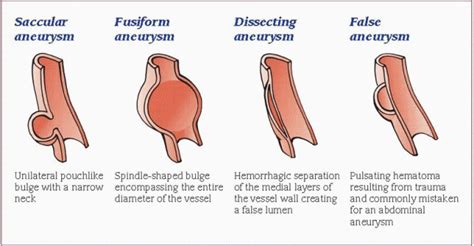 Classification Of Aneurysm Pictures To Pin On Pinterest Pinsdaddy
