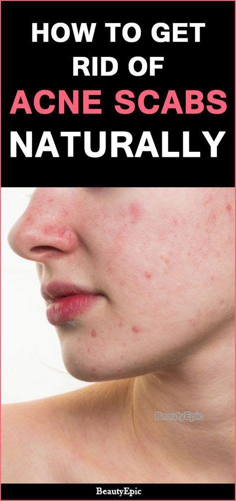 Newclothingdesigns How To Get Rid Of Pustule Acne