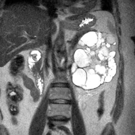 Multilocular Cystic Nephroma Radiology Case