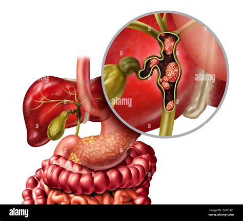 Gallengangskrebs Oder Cholangiocarcinom Mit Gallenblase Und Leber Als