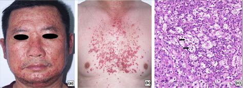 Image Gallery Generalized Cutaneous Rosaidorfman Disease Presenting