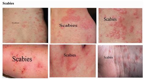Effect Of Skin Diseases In Modernized Life