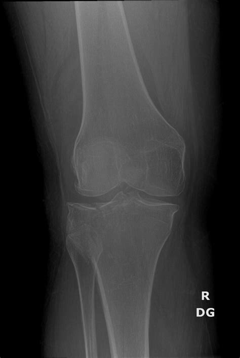 OrthoDx Lateral Tibial Plateau Fracture Clinical Advisor