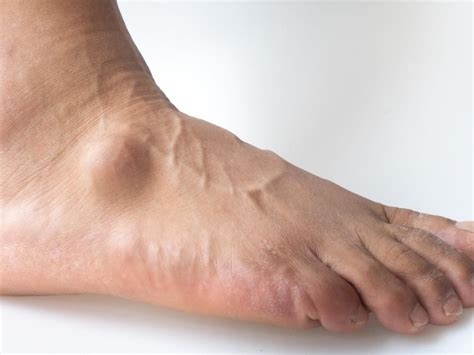 Ganglion Cyst Foot Ganglion Cyst Treatment Foot Health Facts Foot Sexiz Pix