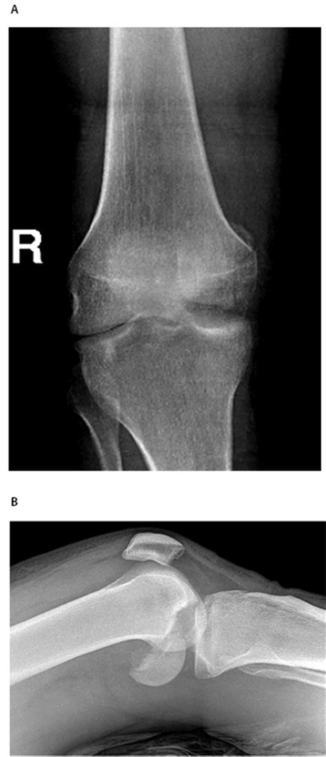 A Novel Technique For Fixation Of A Medial Femoral Condyle Fracture