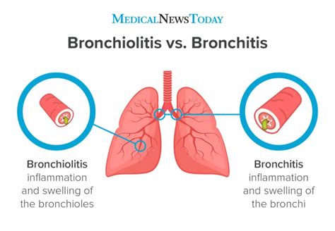 Bronchiolitis Vs Bronchitis Whats The Difference Bronchitis