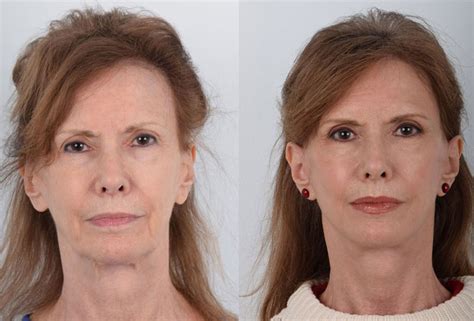 facelift before and after photo gallery dr kenneth kim