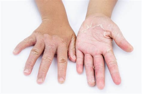 Las Manos Secas Cáscara Dermatitis De Contacto Infecciones Por