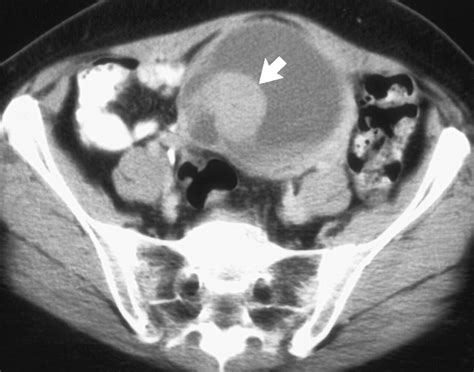 Ct Of Epithelial Ovarian Tumors Radiographics