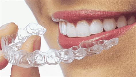 What Are The Benefits Of Clear Teeth Aligners The Sakana