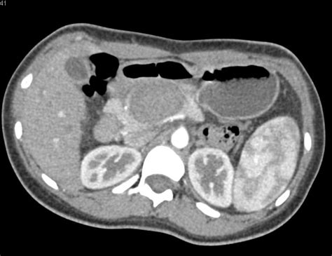 Spen Tumor Pancreas Pancreas Case Studies Ctisus Ct Scanning