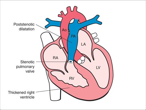 Pulmonary Stenosis Pulmonary Atresia With Intact Ventricular Septum