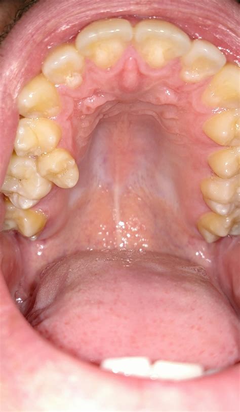 If you really wanted to eat spaghetti with ground beef you could have eaten it the day after your teeth were extracted. Foods To Eat After Wisdom Teeth Removal Reddit - change comin