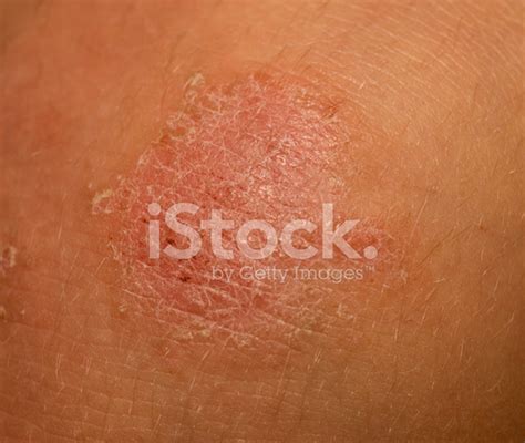 Child Skin With Rash Stock Photo Royalty Free Freeimages