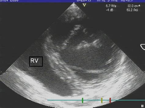 Dysplastic Mitral Valve With A Triangular Opening With The Anterior