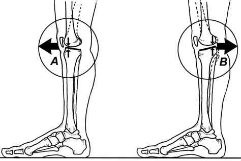 Gait Retraining For Knee Hyperextension Human Locomotion