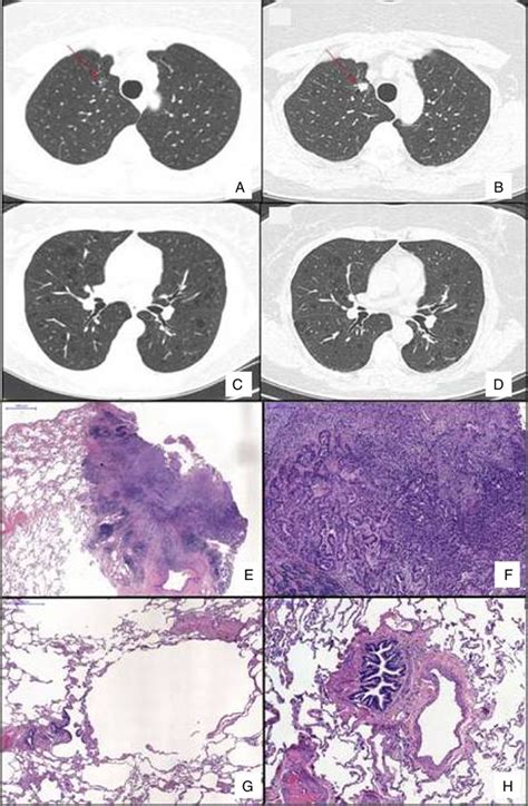 Chest Hrct Scans Showing Diffuse Cystic Lung Disease And A Solitary