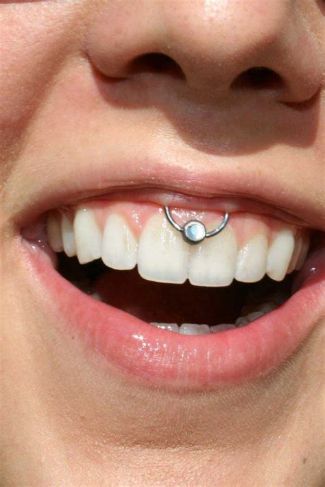 Smiley Piercing Infection