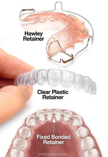 Types Of Dental Retainers Newmarket Dentists Davis Dental Care