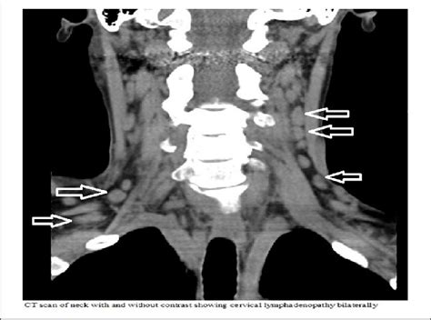 Ct Scan Neck With And Without Contrast Showing Bilateral Cervical