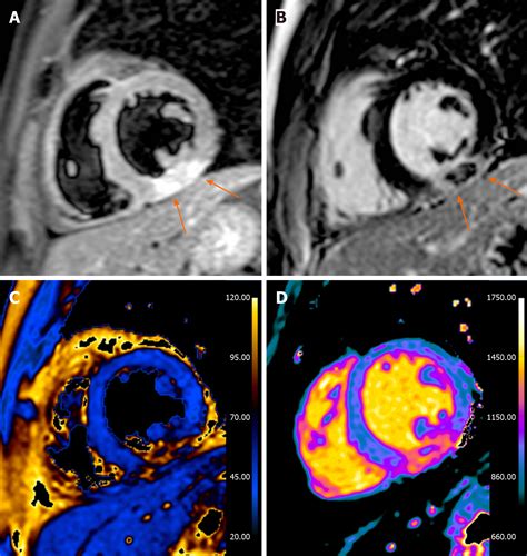 Cardiovascular Magnetic Resonance In Myocardial Infarction With Non