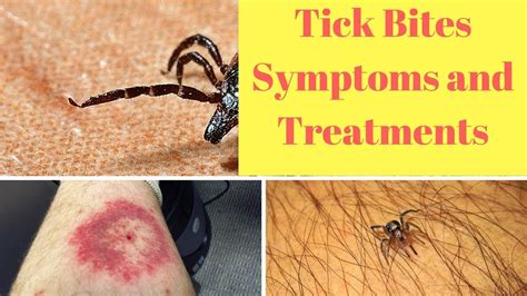 Tick Bites Symptoms And Treatments Youtube