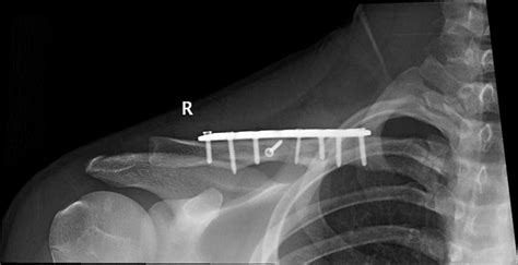 Clavicle Plating System Acumed