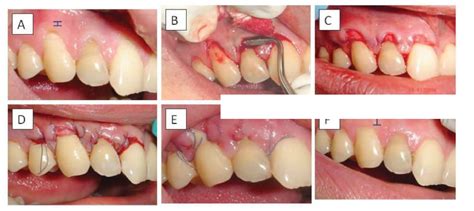 Figure 1 From Modified Tunnel Technique For Management Of Gingival