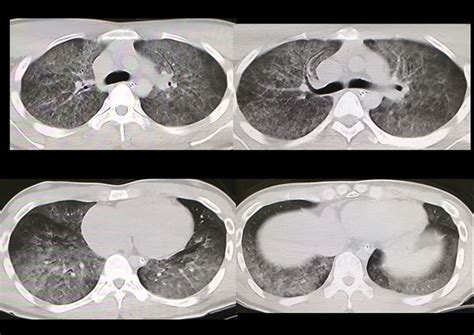 Postmortem Pulmonary Thoracic Ct Findings Ct Reveals Diffuse Lung