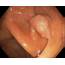 What Is A Colon Polyp  BowelPrepGuide