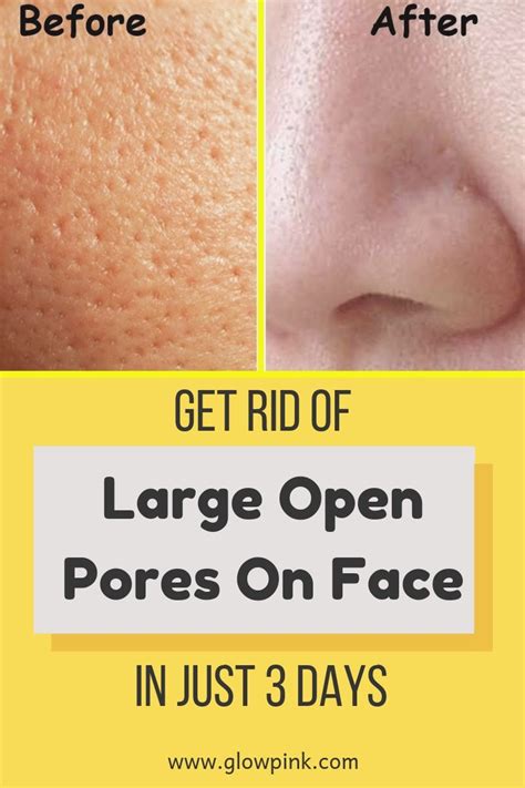 Pin By Izosimodincov On Beauty Open Pores On Face Facial Skin Care