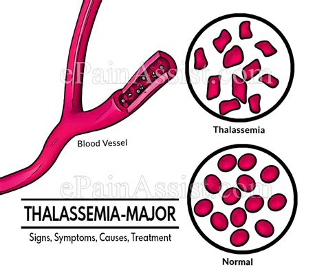 Thalassemia Major Signs Symptoms Causes Treatment Complications