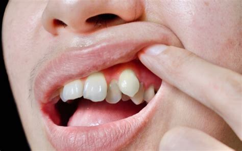 14 Common Causes Of Gum Pain