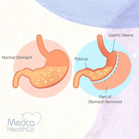 Gastric Sleeve Surgery Medco Healthco Stay Safe And Healthy