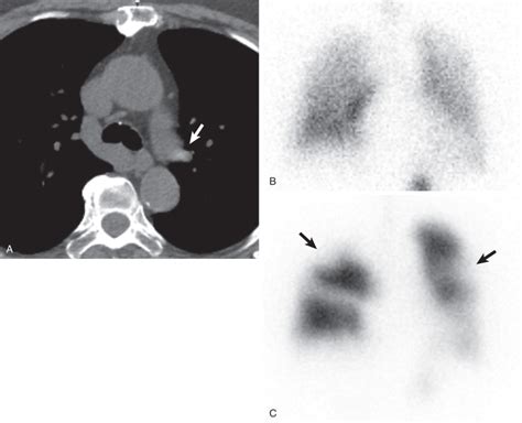 Acute Pulmonary Embolism Radiology Key