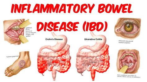 An Introduction To Inflammatory Bowel Disease Contributing Factors To Ibd Development Youtube