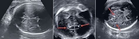 Fetal Cerebral Ultrasound Of A Fetus With Multiple Cr At 35 Gw A No