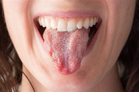 Fungal Infection In Mouth Thrush And The Throat Fungal Infections