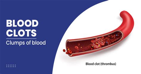 Blood Clots Symptoms Causes Risk Factors And Treatment