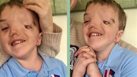 Mum Slams Instagram For Removing Photo Of Son With Facial Deformity Im Beyond Disgusted
