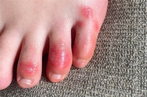 Covid Toes Other Rashes Latest Possible Rare Virus Signs Positive