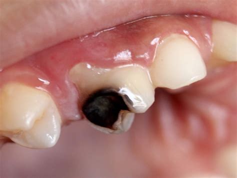 Cavities Dental Caries Health Information